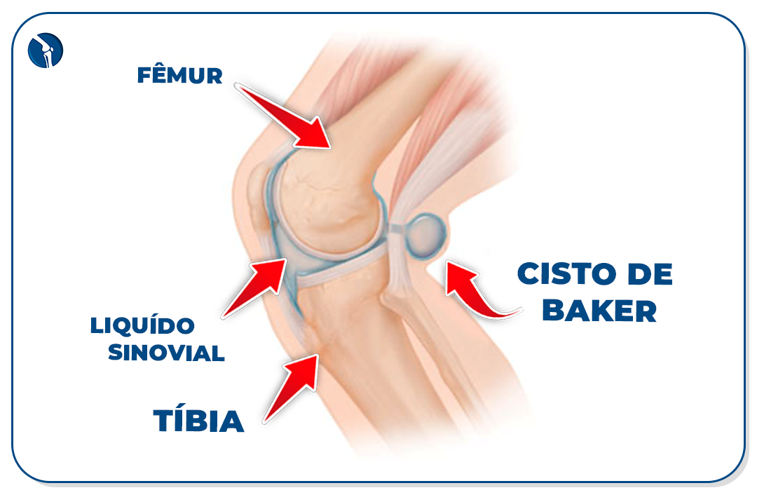 Líquido sinovial e formação do cisto de Baker atrás do joelho