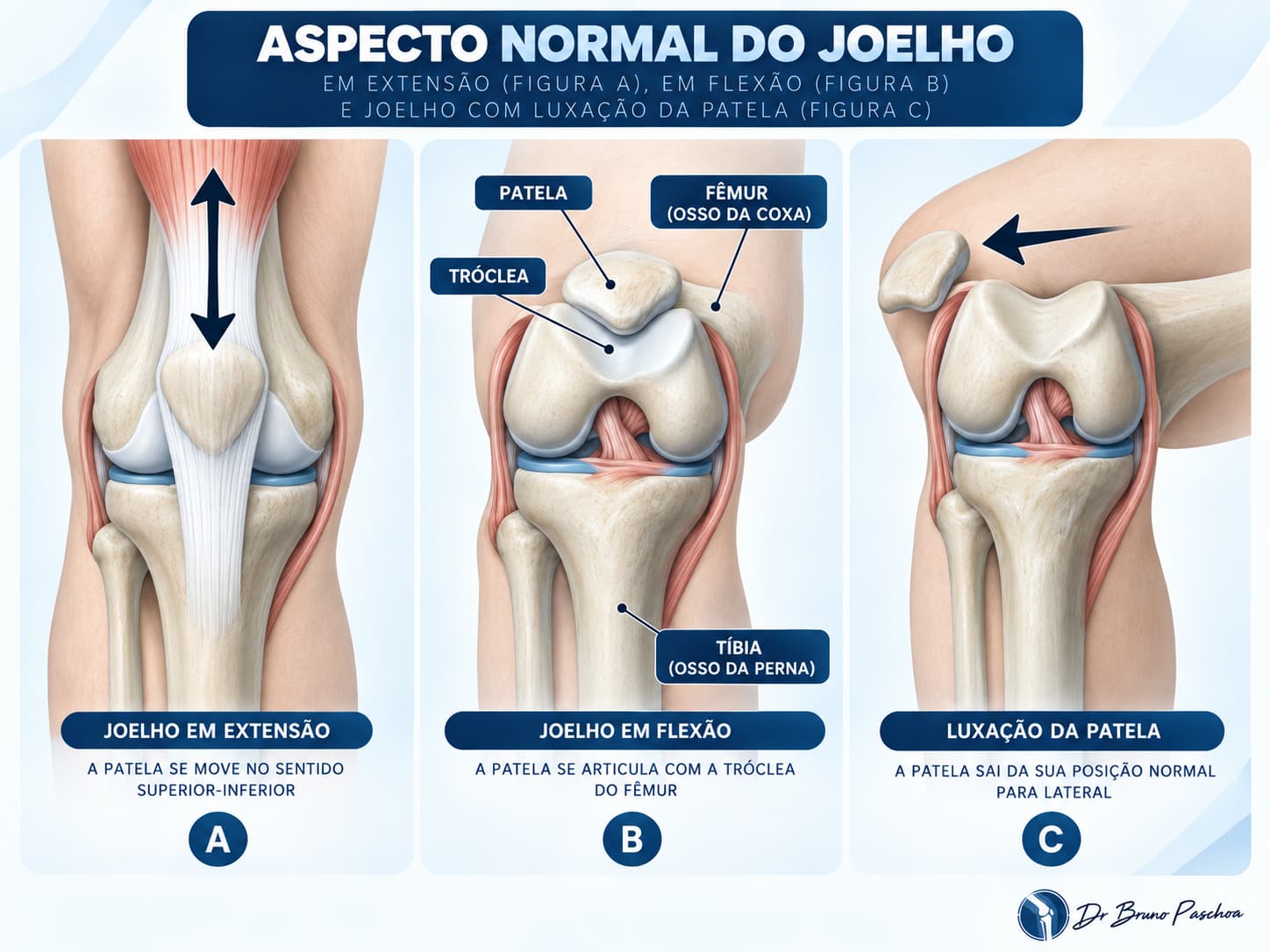 Aspecto normal do joelho em flexão e extensão comparado à luxação da patela