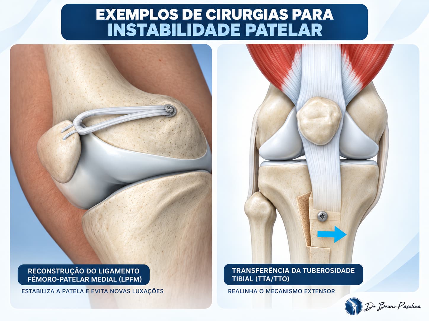 Exemplos de cirurgias para instabilidade patelar