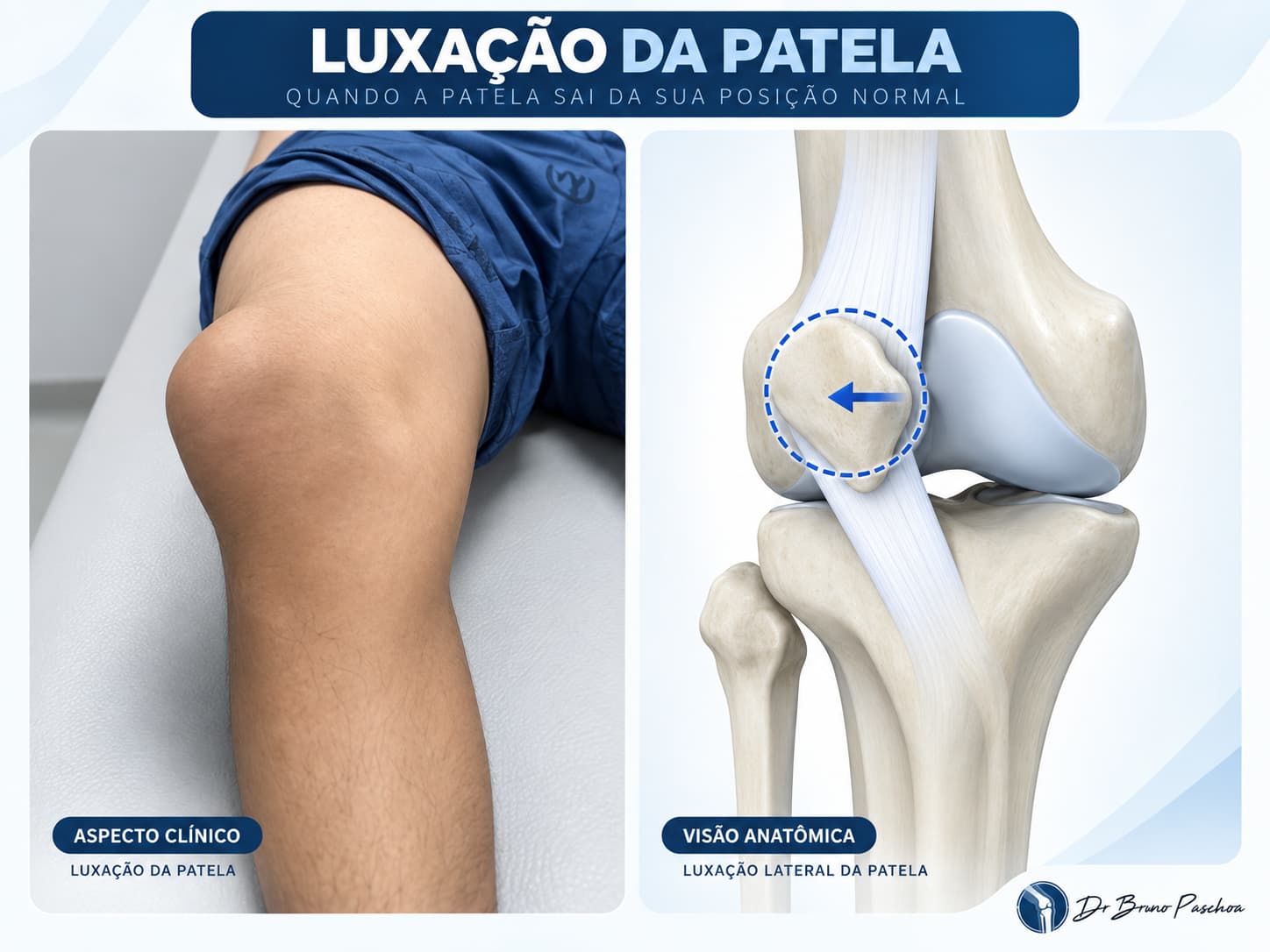 Aspecto do joelho com luxação da patela