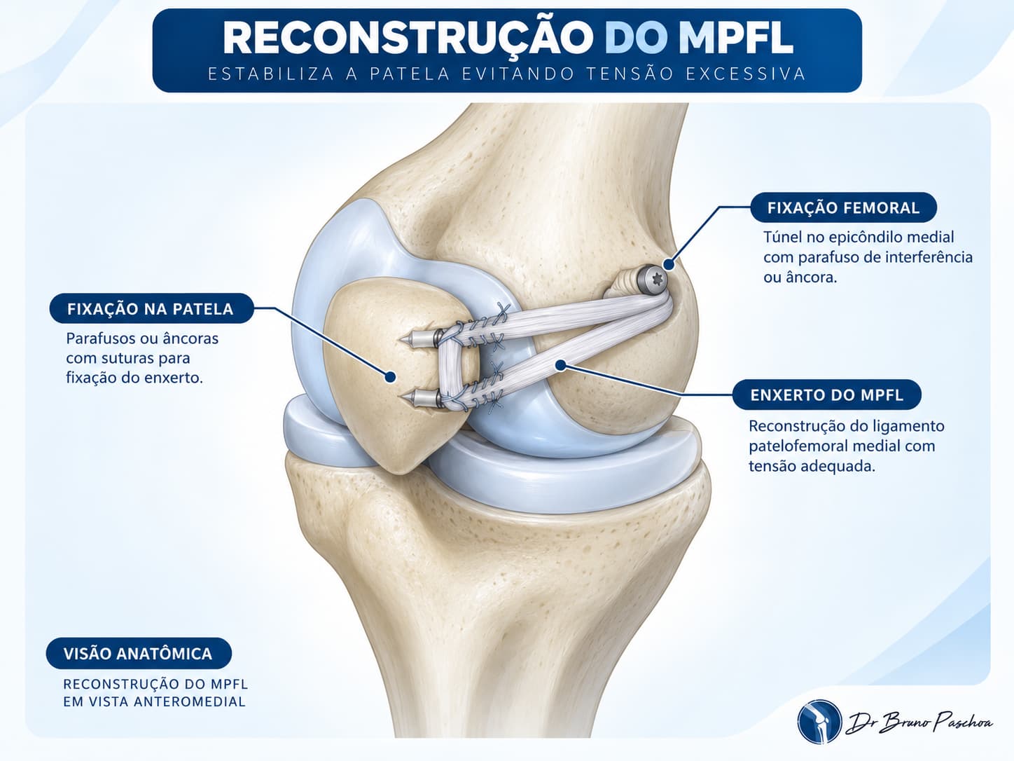 Reconstrução do ligamento patelofemoral medial (LPFM)
