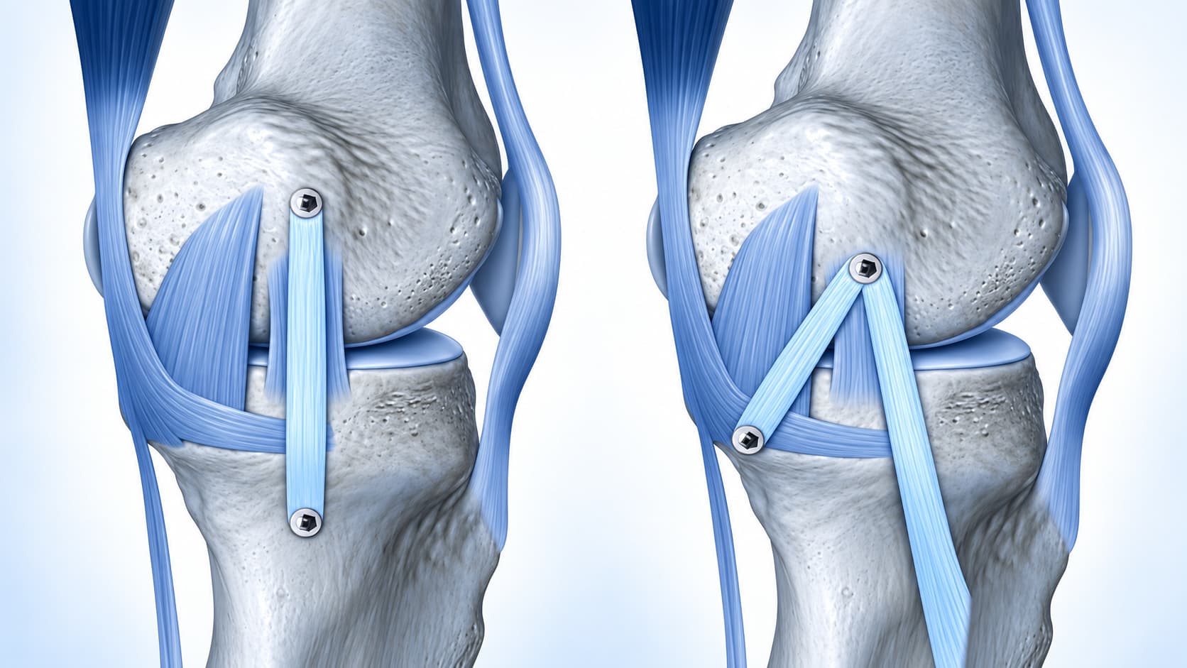 Reconstruções do ligamento colateral medial e retorno ao esporte