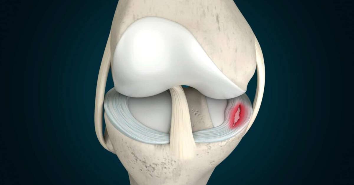Anatomia do joelho com menisco medial e menisco lateral