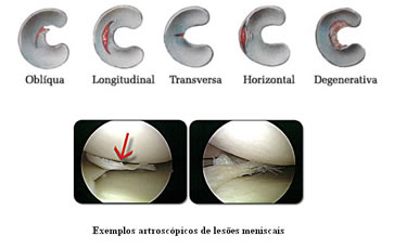 Tipos de lesão meniscal e exemplos artroscópicos