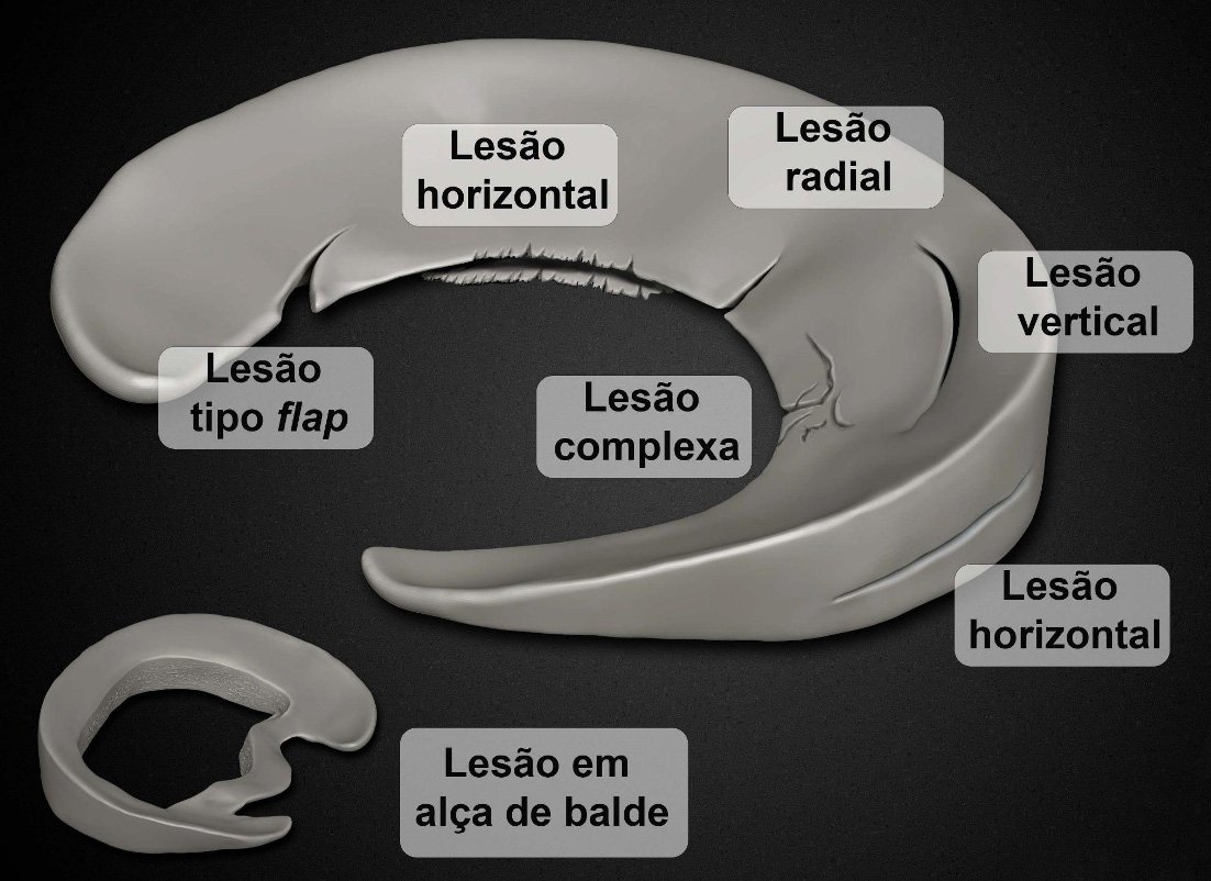 Classificação das lesões do menisco: horizontal, radial, vertical, flap, complexa e alça de balde