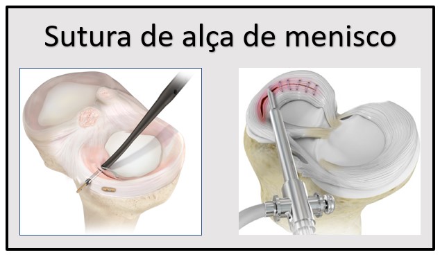 Zonas vermelha e branca do menisco e padrões de lesão longitudinal, oblíqua e radial