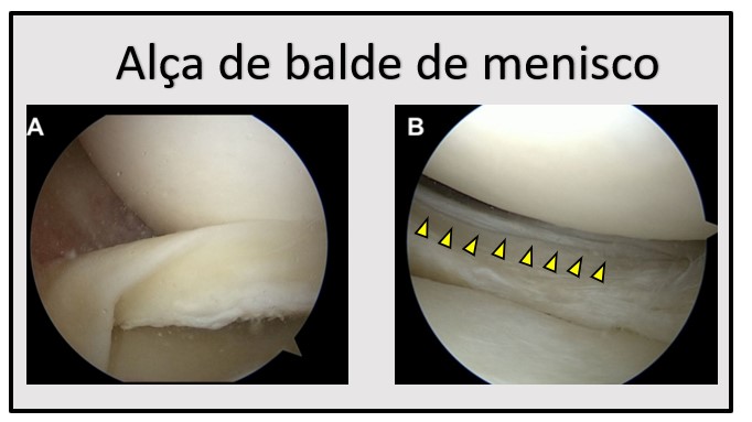 Lesão meniscal complexa vista por artroscopia