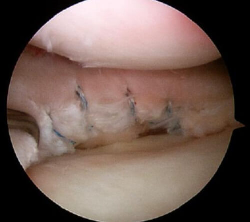 Ilustração da sutura meniscal