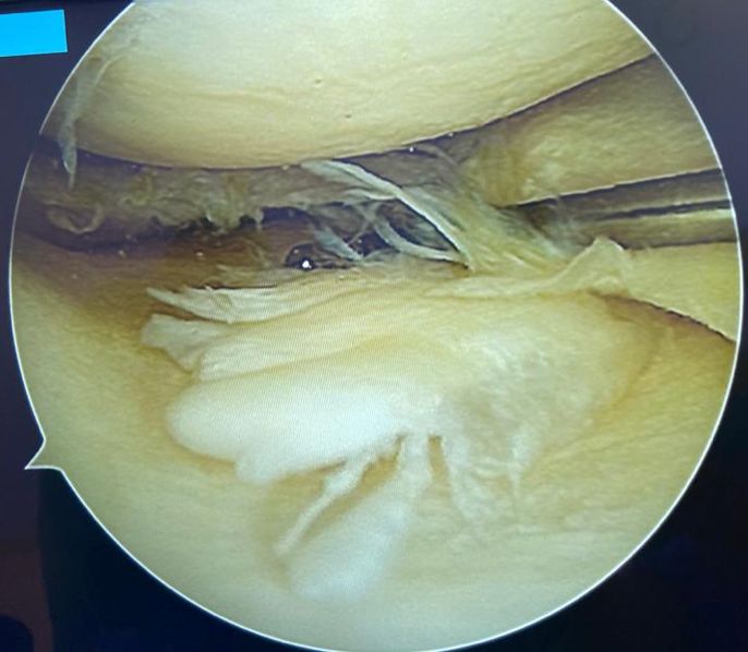 Reinserção da raiz meniscal