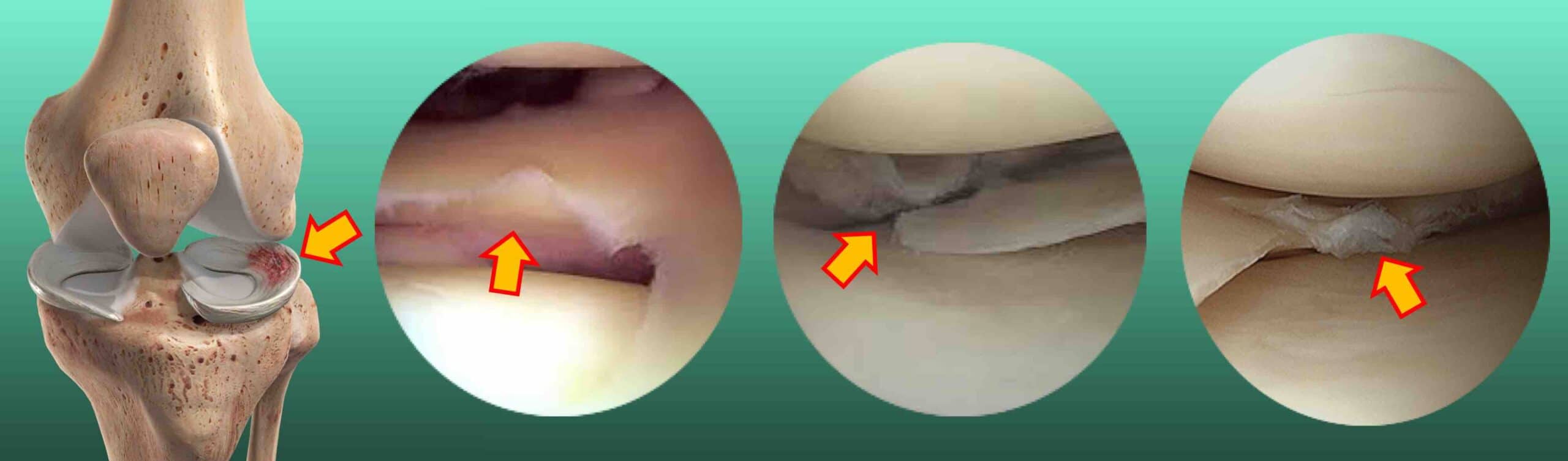 Lesão em alça de balde do menisco antes e depois do reparo