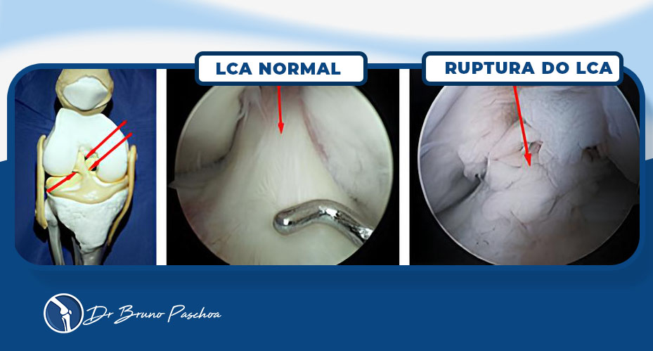 Comparação artroscópica entre LCA normal e ruptura do LCA