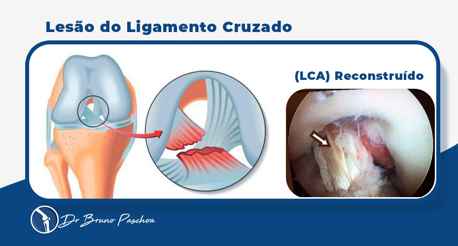 Ilustração da lesão do ligamento cruzado anterior e imagem artroscópica do LCA reconstruído