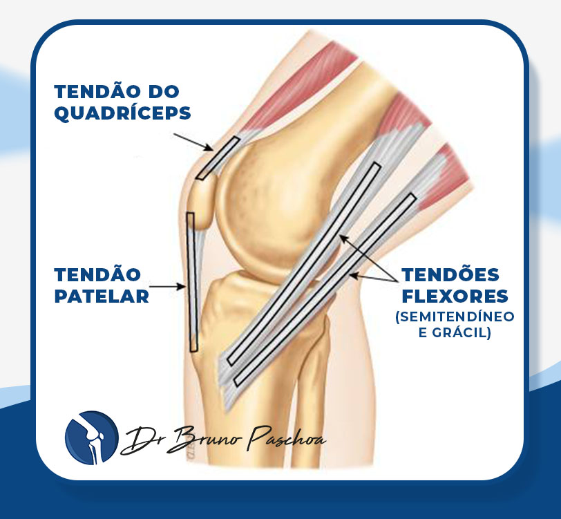 Tipos de enxerto para reconstrução do LCA: tendão do quadríceps, tendão patelar e tendões flexores