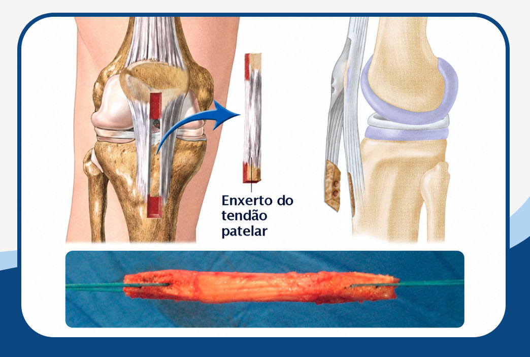 Retirada e preparo do enxerto do tendão patelar para reconstrução do LCA