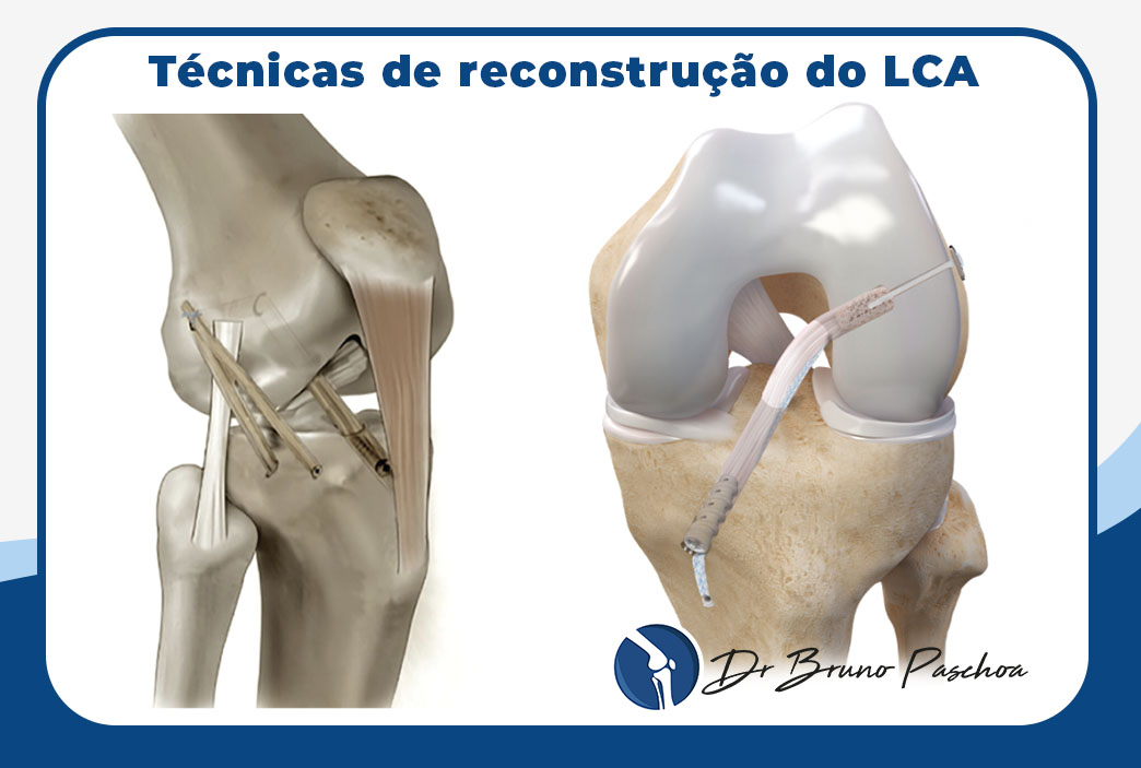 Técnicas de reconstrução do LCA com fixação do enxerto no fêmur e na tíbia